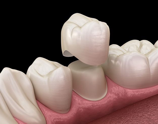 Dental crown placement illustration showing ceramic tooth crown being fitted over prepared tooth on pink gum model.