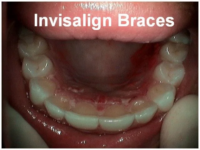 Open mouth displaying lower teeth with clear invisalign braces applied to dental alignment.