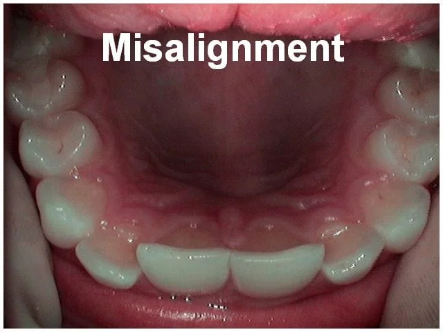 Front view of misaligned lower teeth showing dental malocclusion requiring orthodontic treatment.