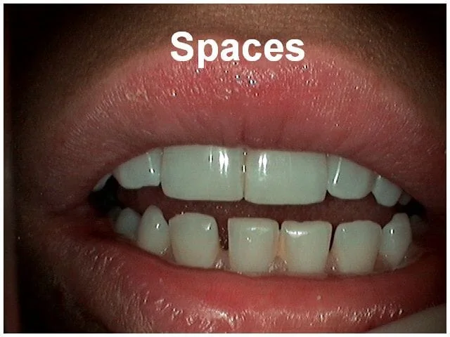 Close-up of teeth with visible gaps between them, demonstrating dental spacing issue.