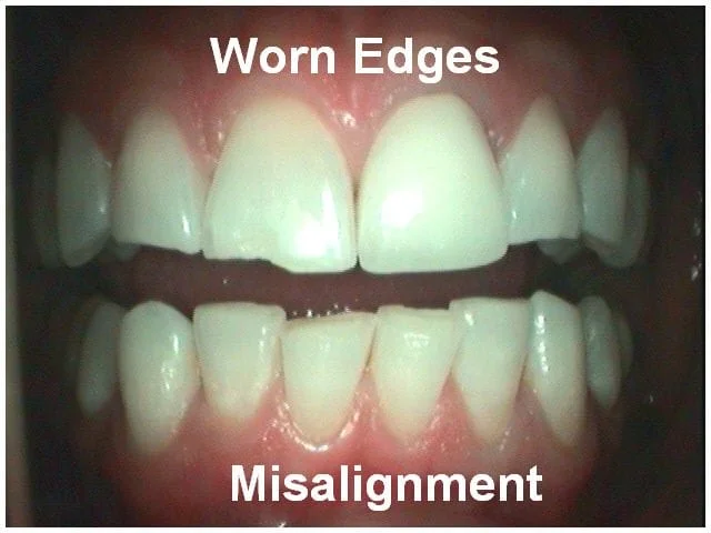Dental condition display showing worn tooth edges and misaligned teeth from West River Dental Care.