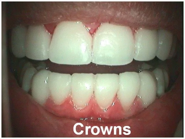 Dental crowns displayed on upper and lower teeth showing cosmetic restoration procedure results.