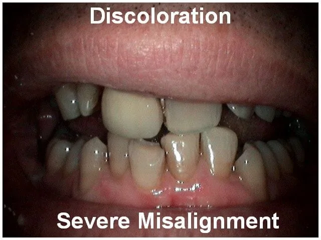 Dental conditions showing tooth discoloration and severe misalignment of upper and lower teeth.