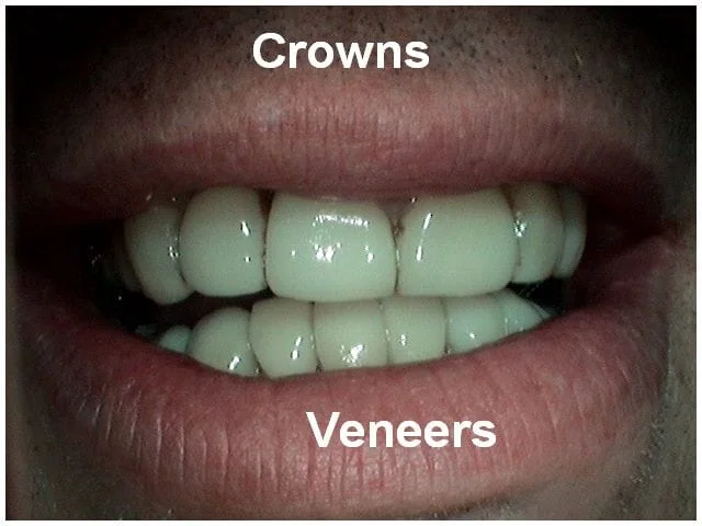 Close-up of teeth showing dental crowns on upper teeth and veneers on lower teeth.