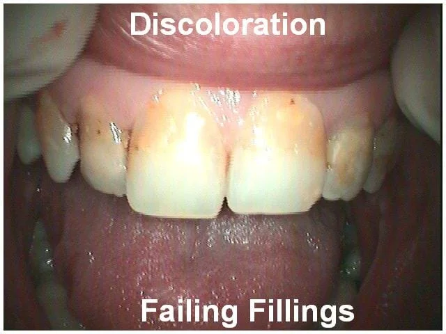 Dental patient's front teeth showing discoloration and failing fillings requiring treatment.