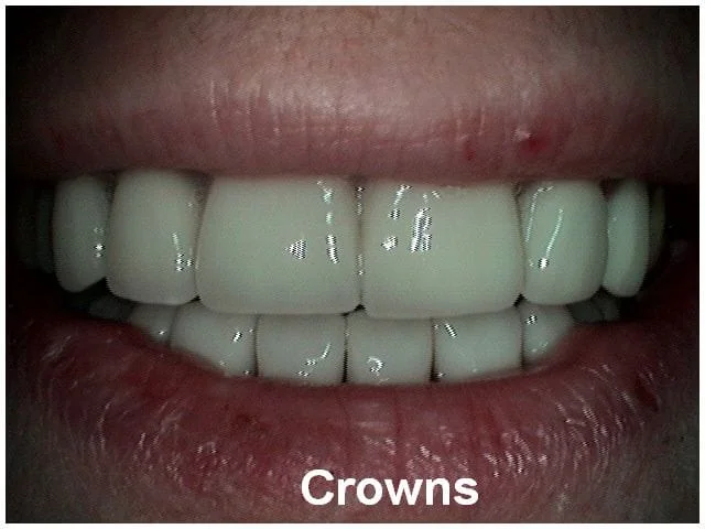 Dental crowns displayed on upper and lower teeth showing cosmetic restoration results