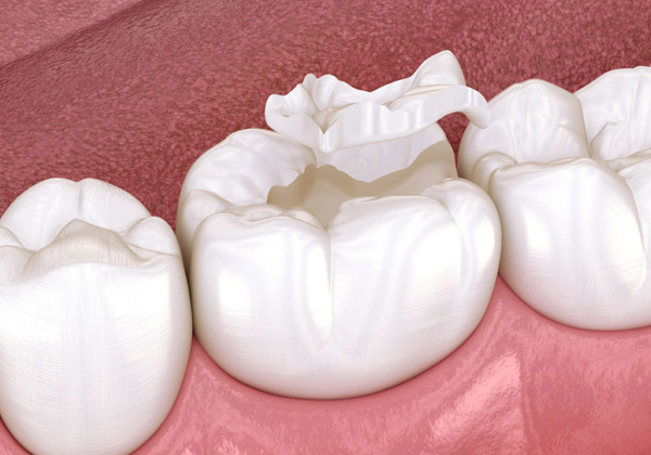 Three white dental crowns displayed on pink gum model showing tooth restoration solutions.