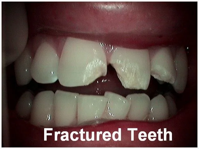 Close-up intraoral view of fractured upper front teeth with visible dental damage and gaps.