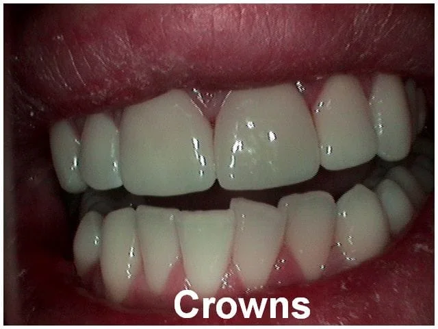 Dental crowns displayed on upper and lower teeth showing restoration results in mouth.