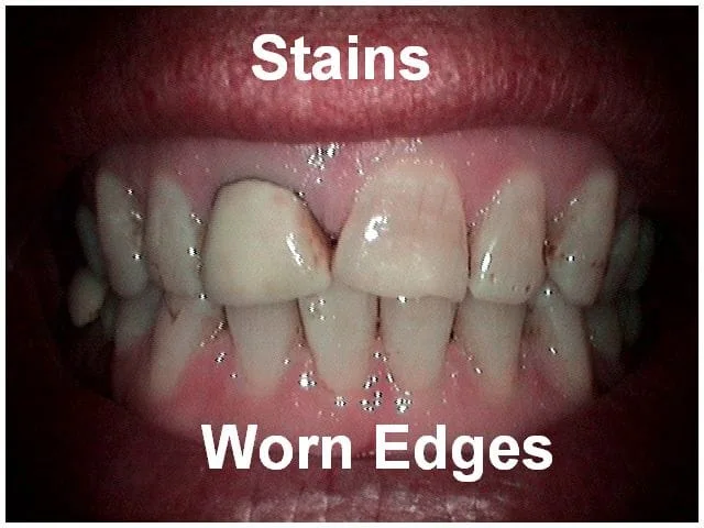Dental closeup showing upper teeth with visible stains and worn edges on front incisors.