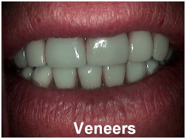 Close-up of dental veneers applied to upper front teeth showing cosmetic dental restoration.